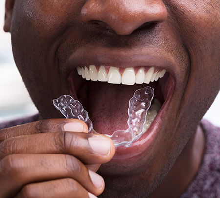 closeup of a person inserting clear aligners onto their teeth